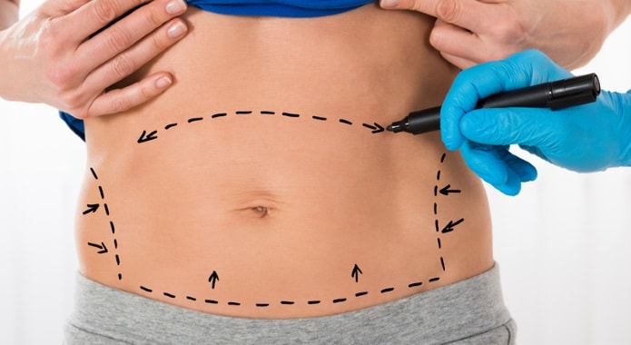 abdominoplasty-min